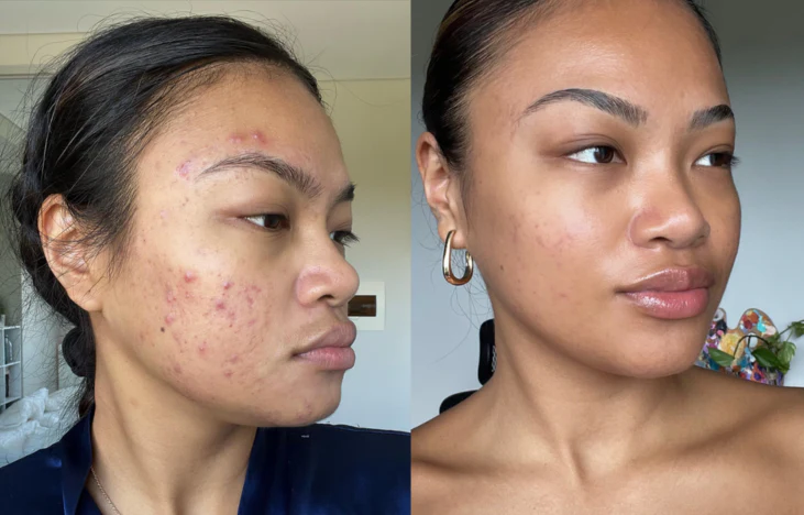 Before and after testimonial from a tbh skincare / Breakout Hack user — significant reduction in acne and inflammation between the two photographs