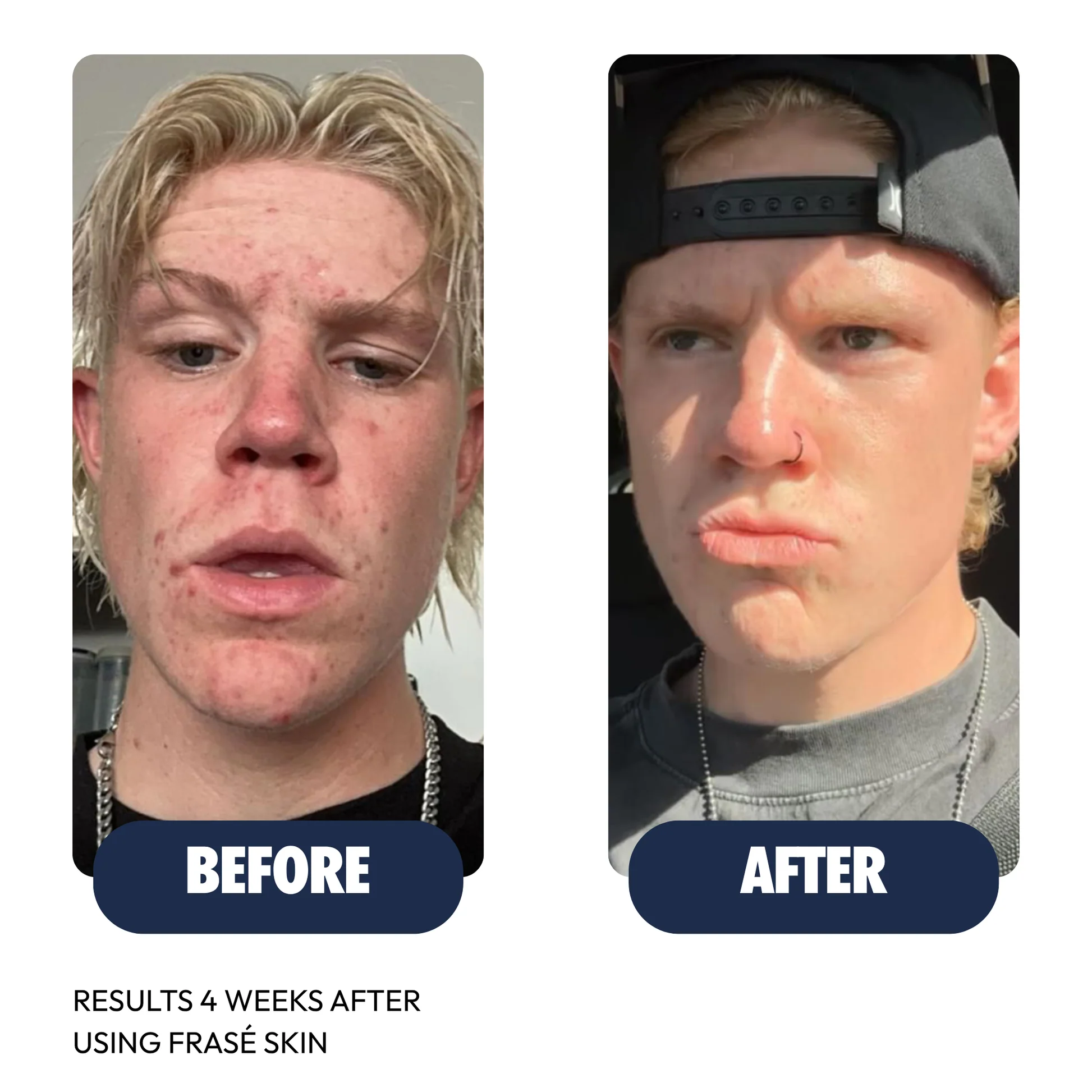 Frasé Skin four-week test result