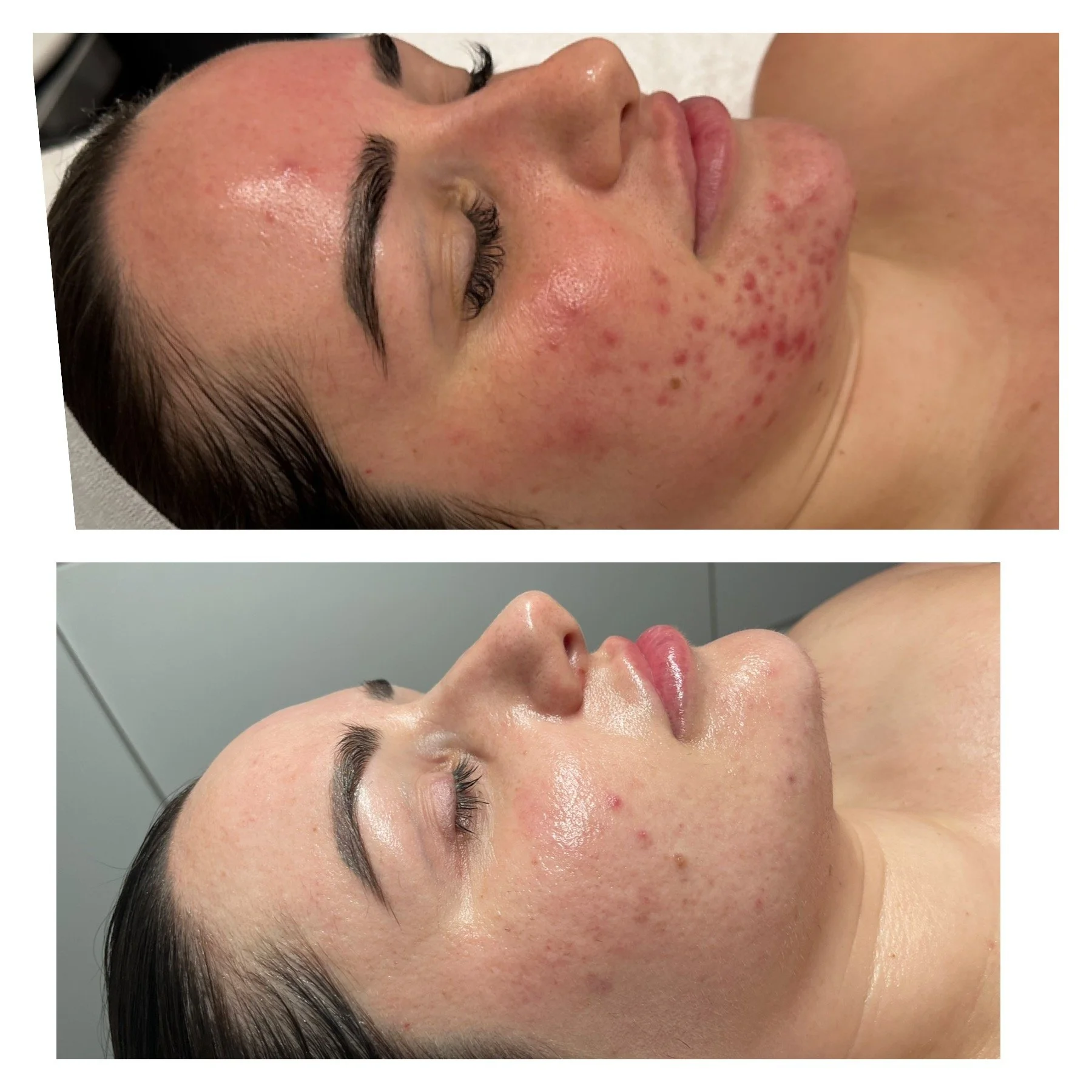 Skin by Kamé facial contouring &mdash; advanced chemical peels for cheeks, jaw, chin
