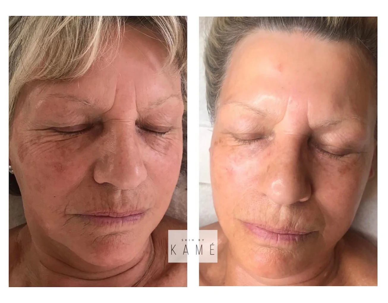 Skin by Kamé anti-wrinkle treatment editorial